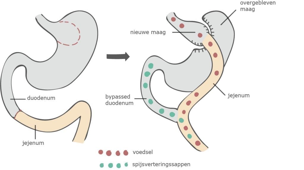 De gastric bypass operatie, werkwijze, voor en nadelen. Maagverkleining.info