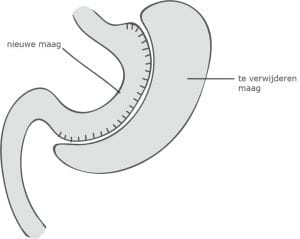 gastric sleeve