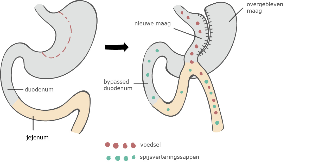 mini gastric bypass